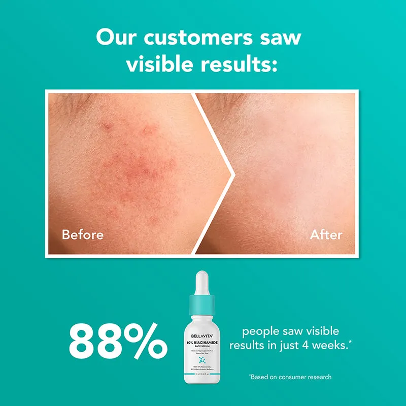10% Niacinamide Face Serum - 10ml